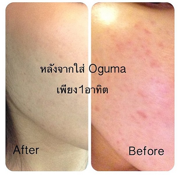 สเปร์ยน้ำแร่โอกูม่าพร้อมส่ง (Oguma Aquakey Intense) โด่งดังในประเทศญี่ปุ่นไต้หวันช่วยเรื่องสิวผดผื่น อาการแพ้ต่างๆ เมคอัพติดทน ขับสิ่งสกปรกใต้ผิวหนัง ไขมันใต้ผิว ต้นเหตุของการเกิดสิว สิวอุดตันหาย